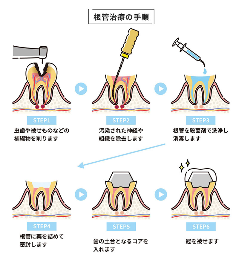 根管治療の手順