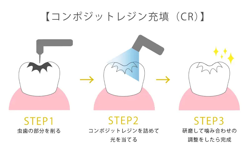 コンポジットレジン充填