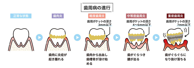 歯周病の進行
